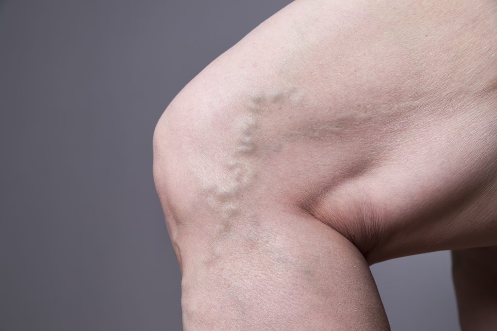 Close up of varicose vein in leg. 