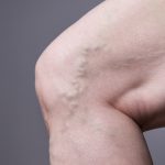 Close up of varicose vein in leg.