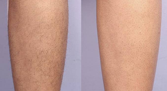 before and after diolaze laser hair removal