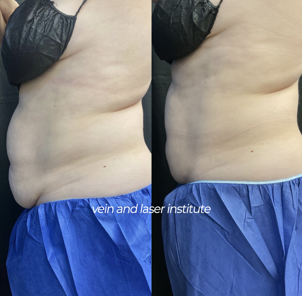 vli coolsculpting before and after abdomen