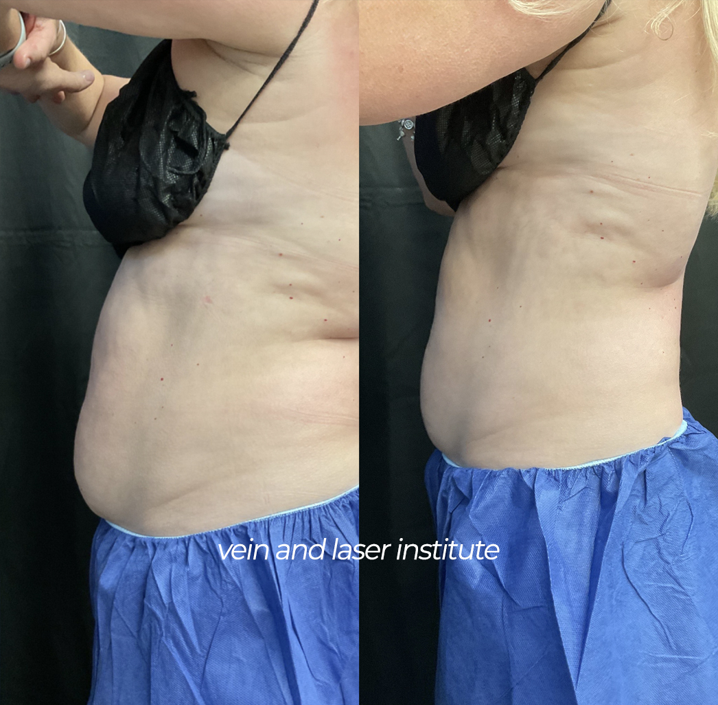 vli coolsculpting before and after abdomen