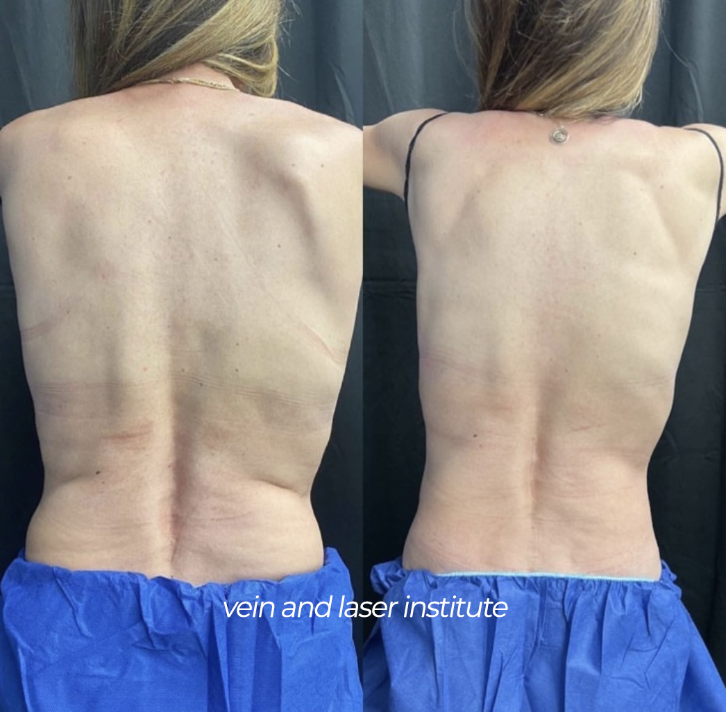 vli coolsculpting before and after flanks