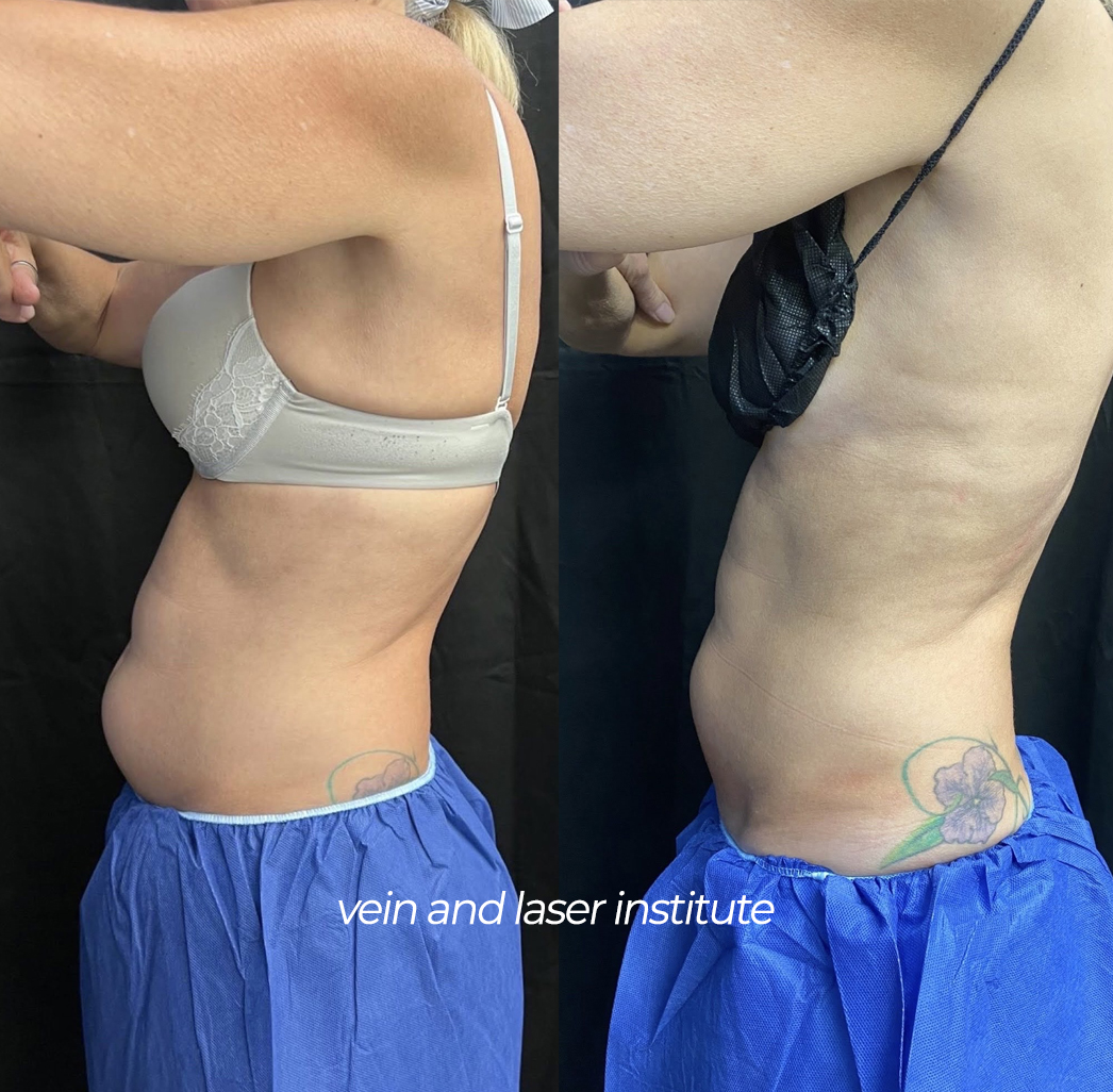 vli coolsculpting before and after abdomen