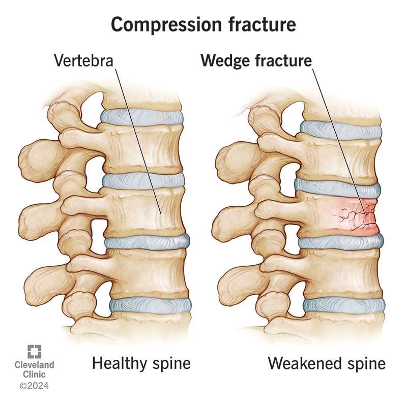 diagram showing healthy spine vs a weakened spine with compression fractures