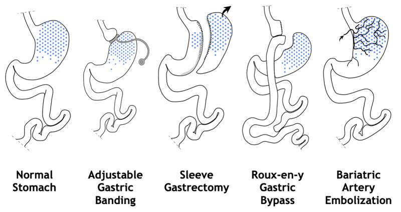 graphic showing different weight loss surgeries