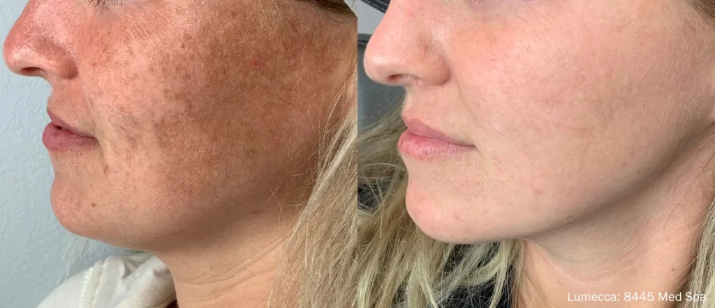 before and after lumeccia ipl