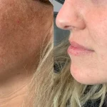 before and after lumeccia ipl