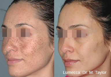 before and after lumeccia ipl