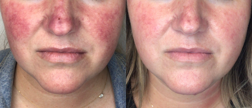 before and after lumeccia ipl