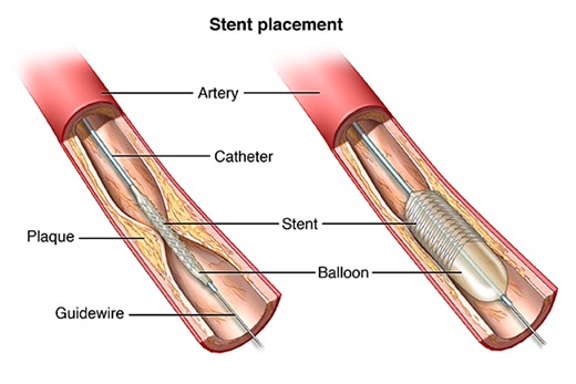 angioplasty diagram