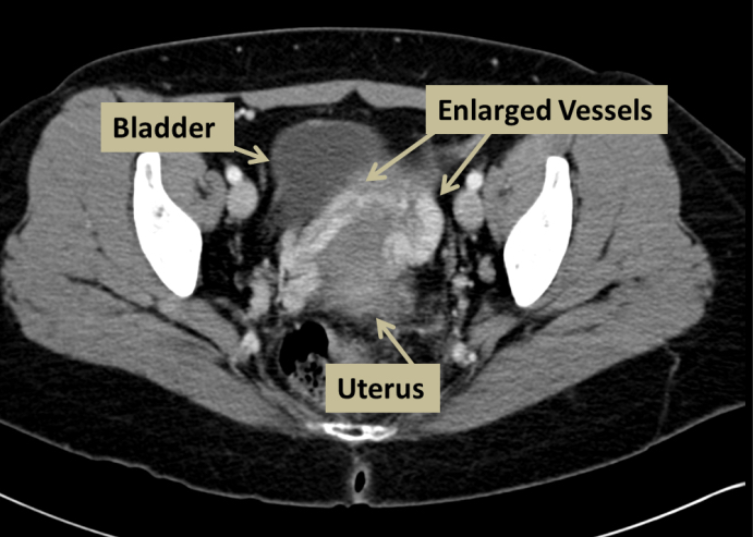 image showing enlarged varicose veins in the pelvis