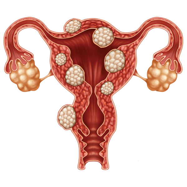 uterine-fibroid