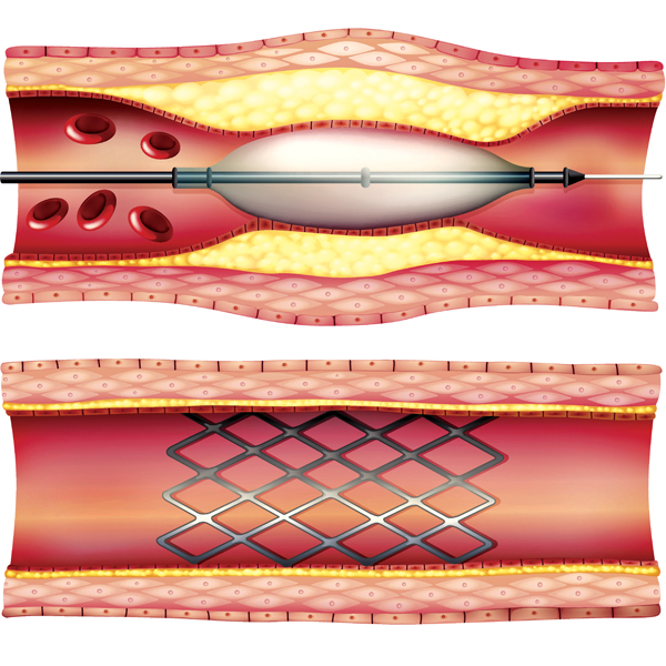 vascular-disease