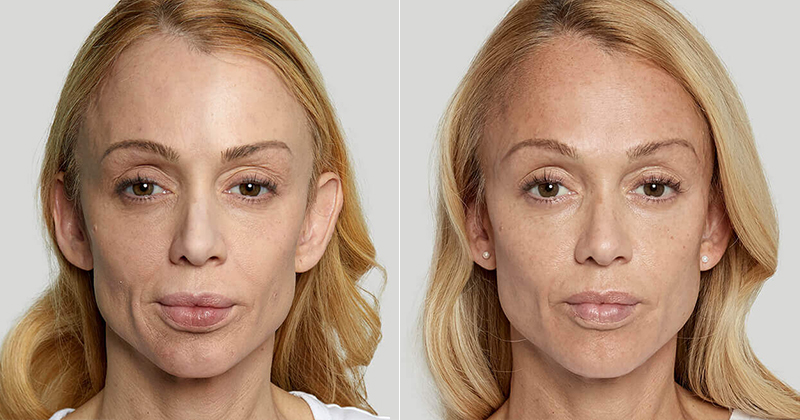 before and after sculptra