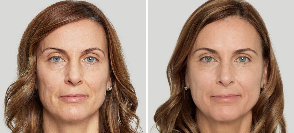 before and after sculptra