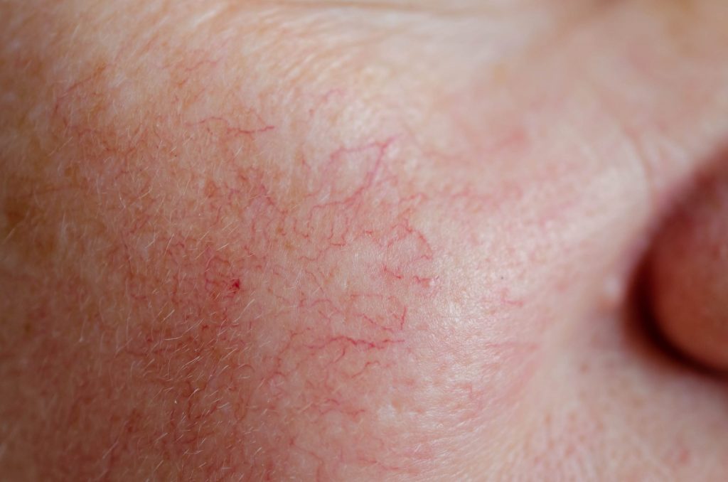 Close up of facial spider veins.