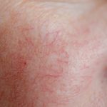 Close up of facial spider veins.