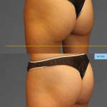 CooleTone before and after glutes