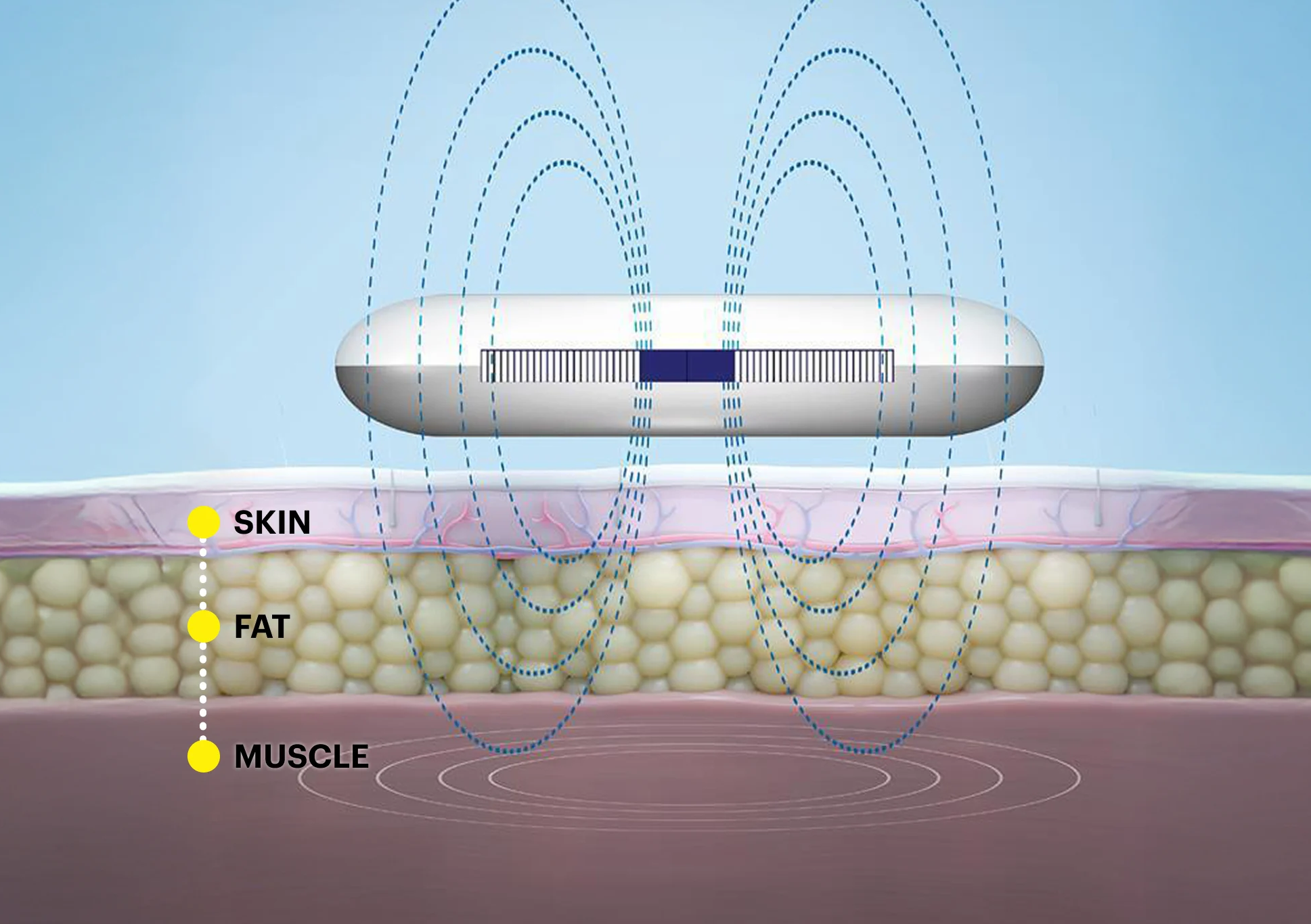 cooltone muscle stimulation treatment diagram