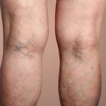 Back of woman's legs with varicose veins.