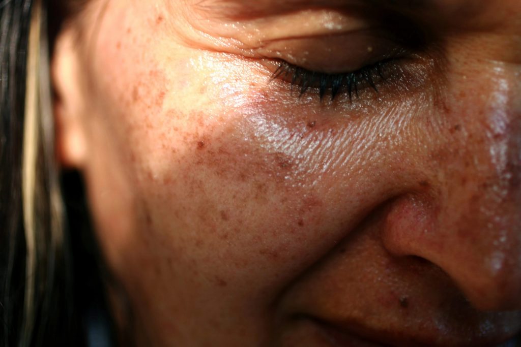 Woman with sun damaged skin.