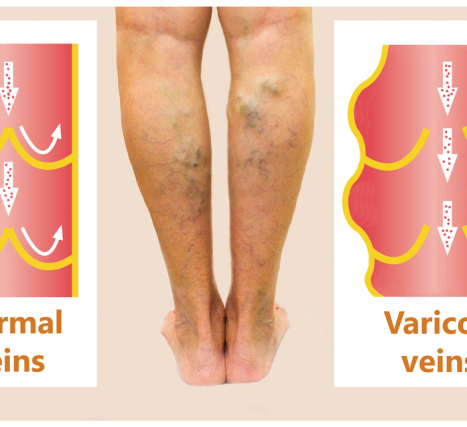 Hidden Signs of Varicose Veins You Might be Missing | Vein & Laser ...