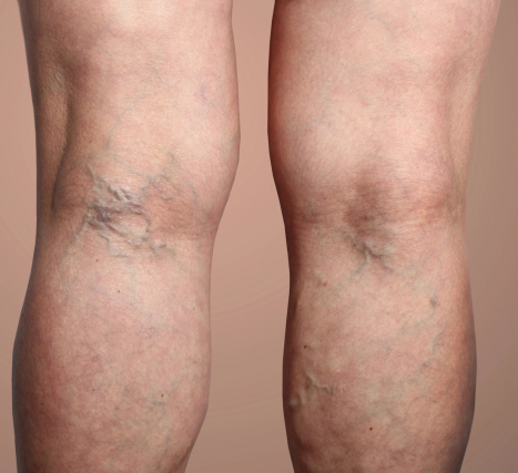 6 Foods That May Help Prevent Varicose Veins